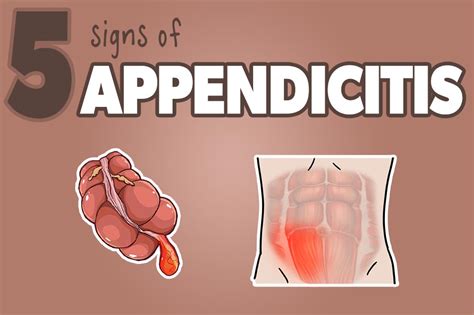 Is appendix essential for life?
